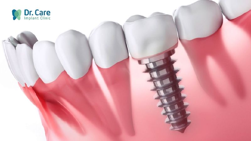 Trồng răng Implant giúp phục hồi răng đã mất do xiết ăn răng