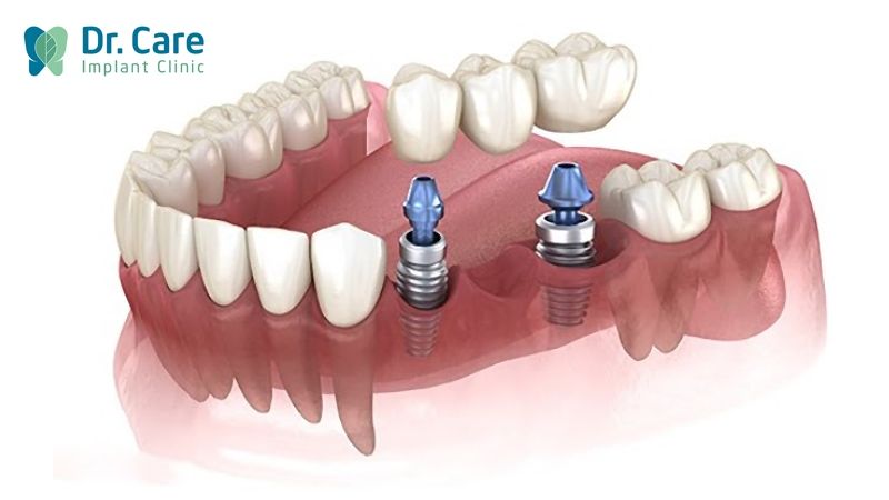 Trồng răng sứ trên Implant (cấy ghép Implant)