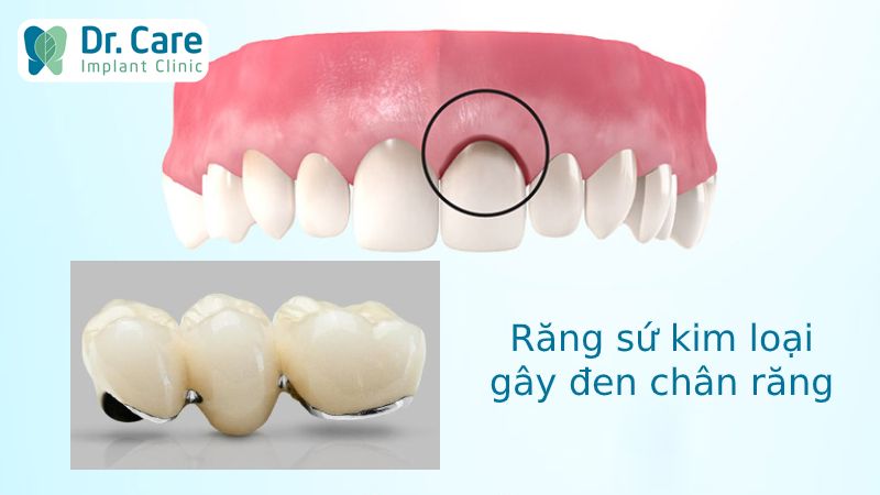 Chân răng bị đen do sử dụng mão răng sứ kim loại