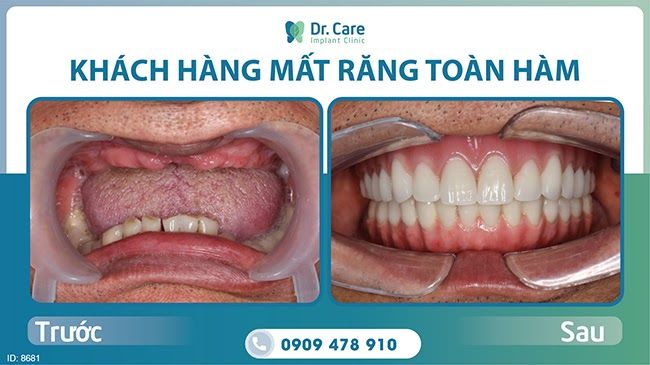 Trồng răng Implant khắc phục khuyết điểm cầu răng sứ