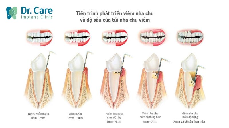  2 giai đoạn bệnh viêm nha chu