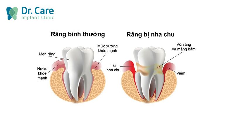 Viêm nha chu là gì?