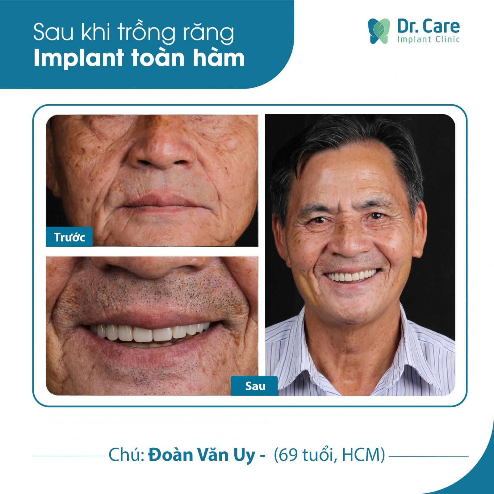 Những trường hợp có thể trồng răng sứ vĩnh viễn trên Implant