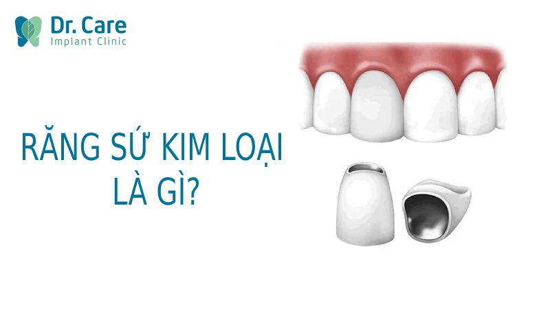 Răng sứ kim loại là gì?