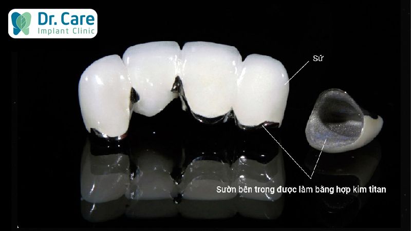 Răng sứ kim loại titan