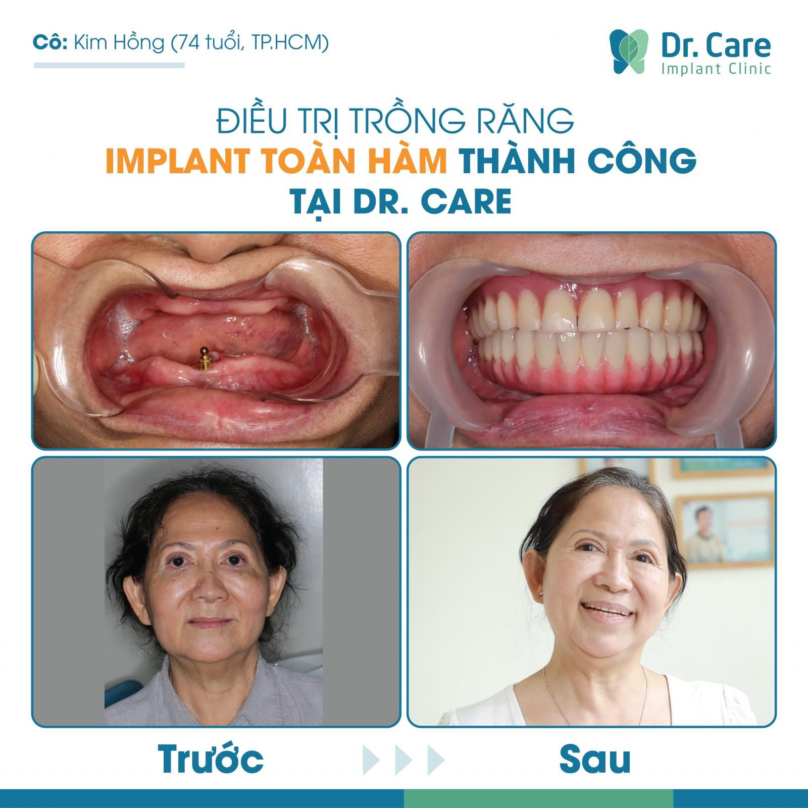 Cấy ghép Implant có cải thiện được tình trạng móm răng không?