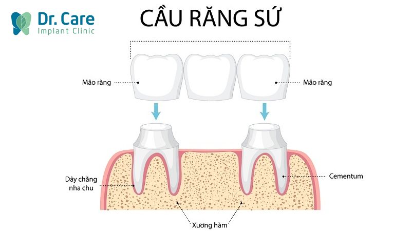 Trồng răng sứ (cầu răng sứ) là gì?