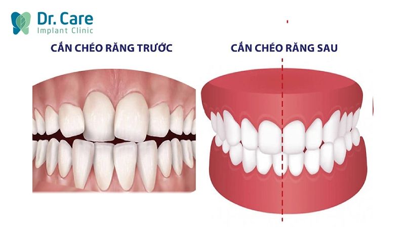 Có mấy loại khớp cắn chéo? Cách nhận biết ra sao?