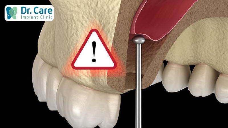 Trường hợp chống chỉ định nâng xoang hàm cấy ghép Implant