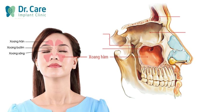 Nâng xoang hàm trong cấy ghép Implant là gì?