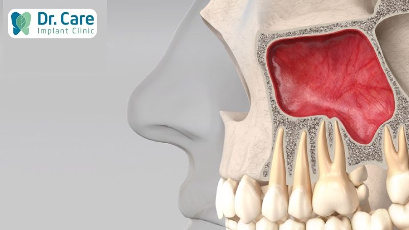 Nâng xoang cấy ghép Implant trong những trường hợp nào?