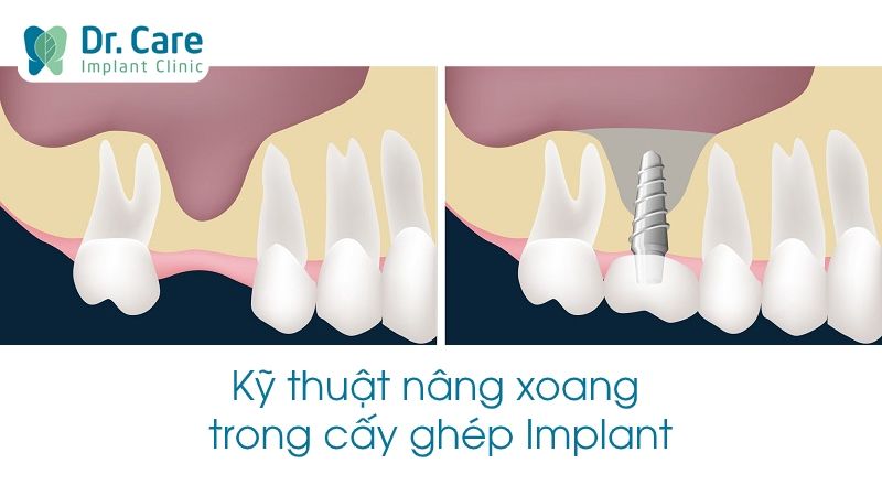 Tầm quan trọng của nâng xoang trong cấy ghép Implant