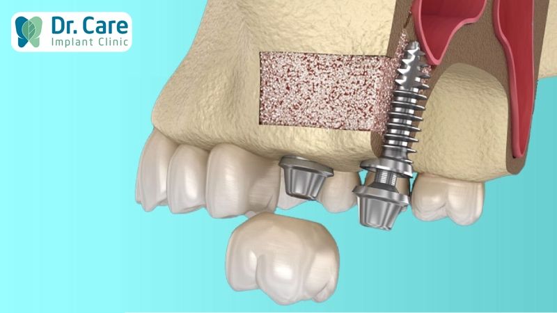  Sau khi nâng xoang có thể cấy ghép Implant ngay không?