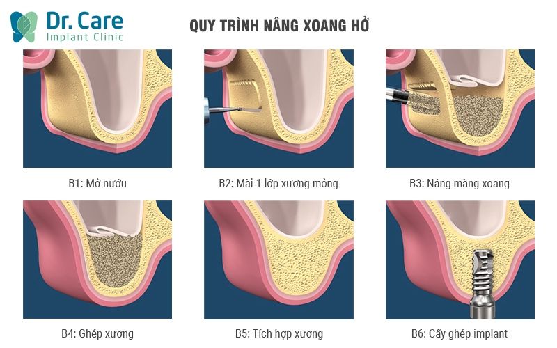 Nâng xoang hở