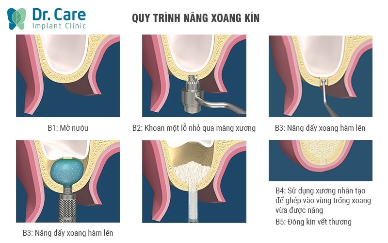 Nâng xoang kín