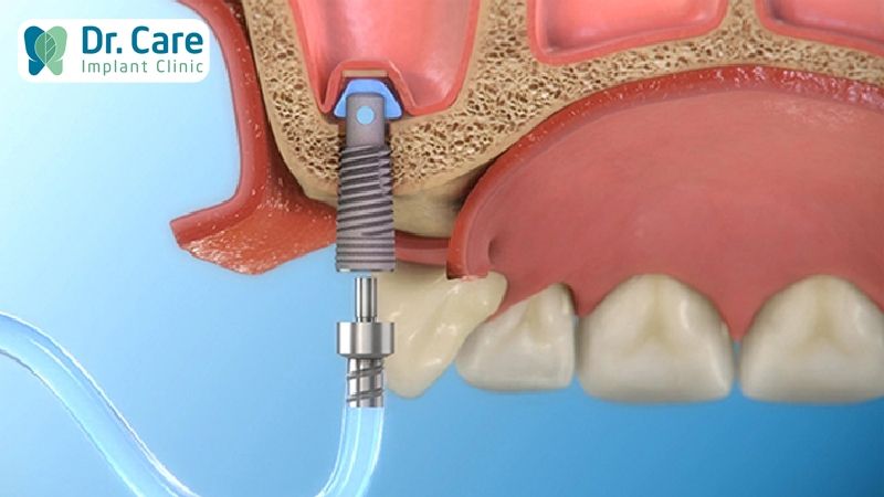 Trực tiếp cấy Implant không cần nâng xoang được không?