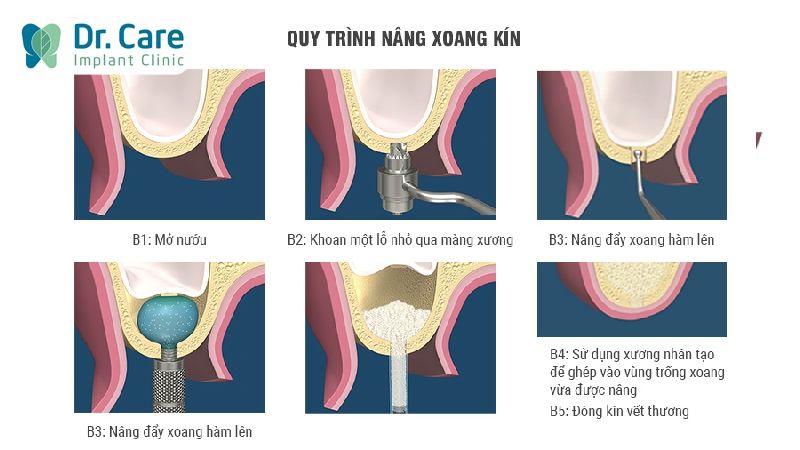 Quy trình nâng xoang kín diễn ra thế nào?