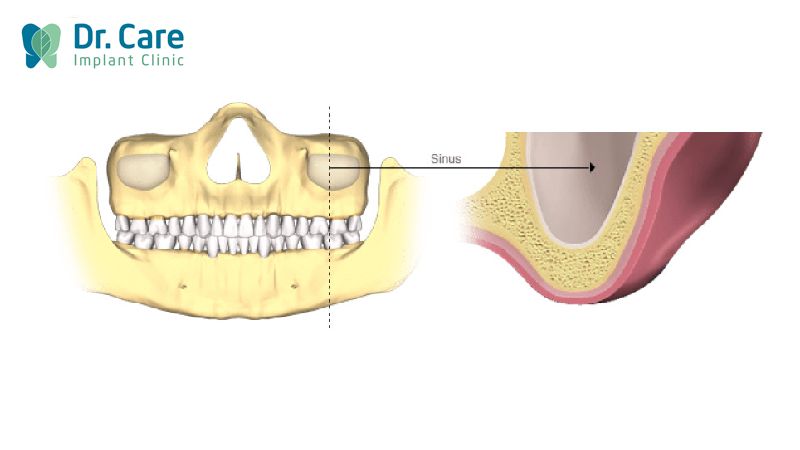 Khi nào cần thực hiện nâng xoang kín?