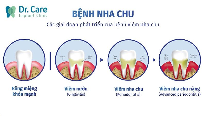 Diễn biến bệnh viêm nha chu theo từng giai đoạn