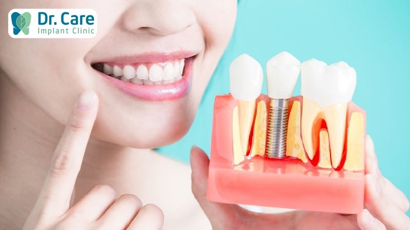 Trồng răng Implant khi mất răng do phát hiện viêm nha chu muộn