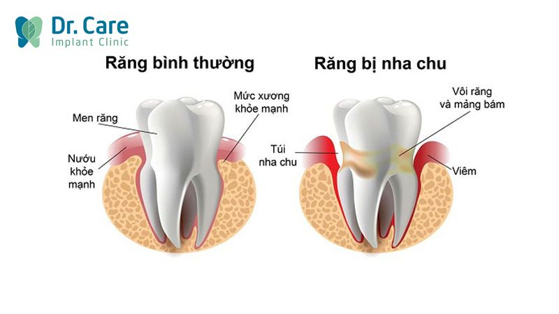 Viêm nha chu là gì? Nguyên nhân gây bệnh viêm nha chu