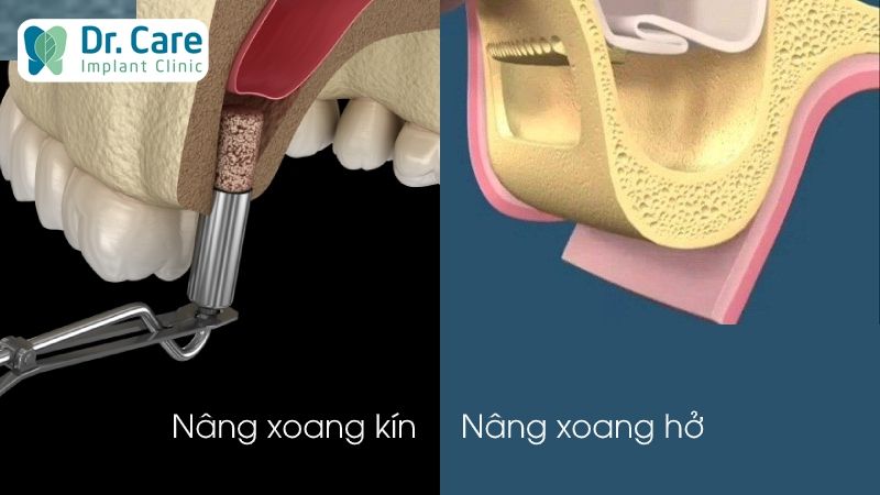 Tìm hiểu 2 kỹ thuật nâng xoang kín và nâng xoang hở