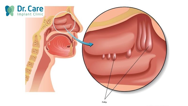 Các trường hợp chống chỉ định khi nâng xoang hàm