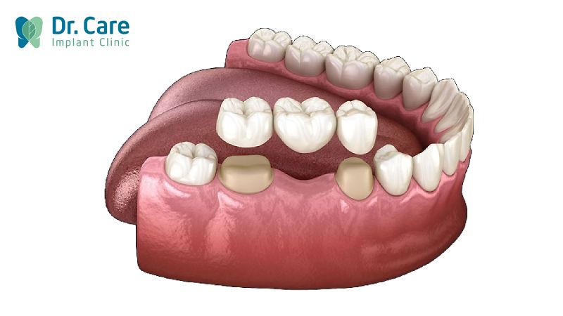 Làm cầu răng sứ cho răng số 6