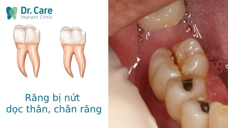 Răng bị gãy do chấn thương hoặc nứt dọc thân, chân răng