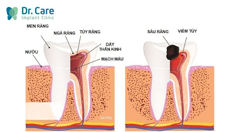 Răng số 6 bị viêm tủy