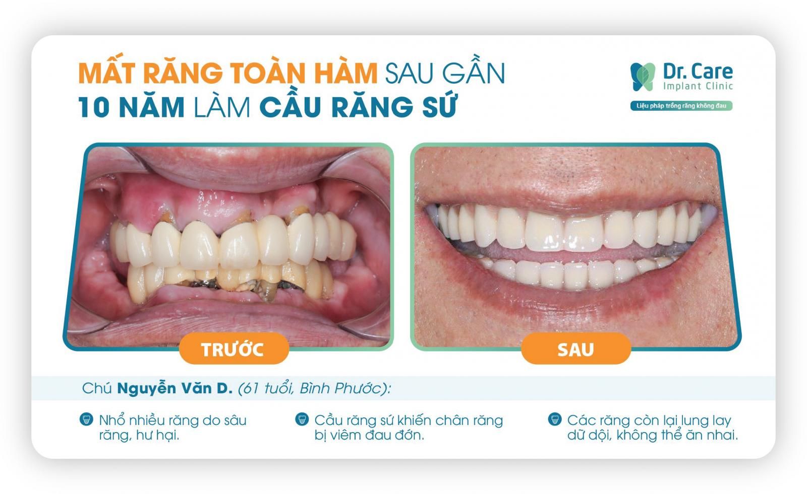 Răng sứ lung lay không thể phục hồi, phải nhổ bỏ