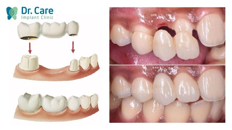 Răng sứ lung lay do cùi răng thật nhiễm bệnh ảnh hưởng đến chân răng