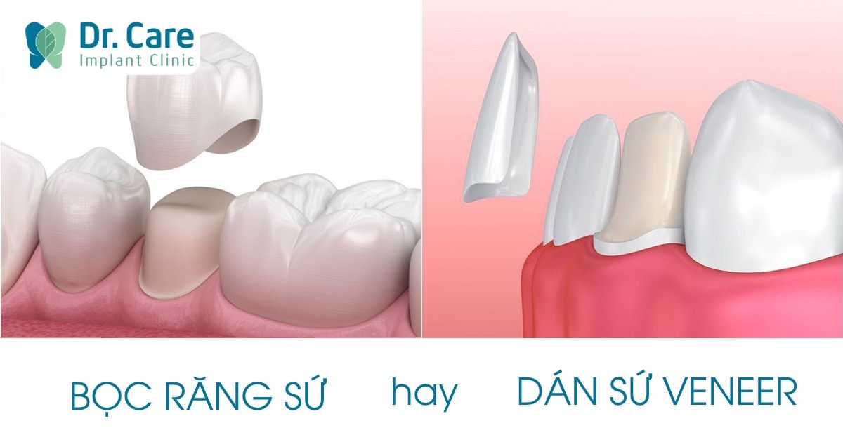 Nên bọc răng sứ hay dán sứ Veneer?