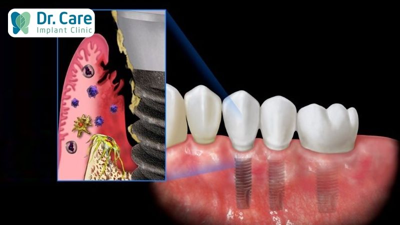 Nguyên nhân gây hôi miệng sau khi cấy ghép Implant