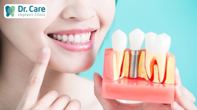 Trồng răng Implant là gì?