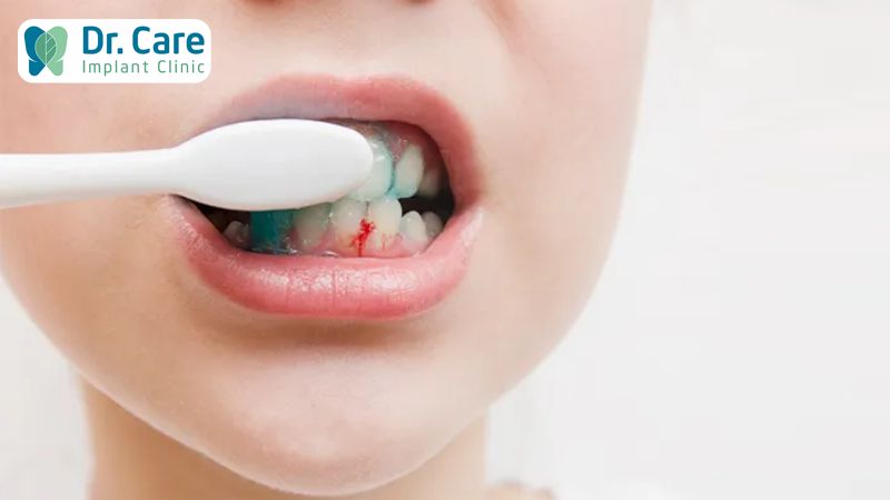 Nguyên nhân gây hôi miệng sau khi cấy ghép Implant