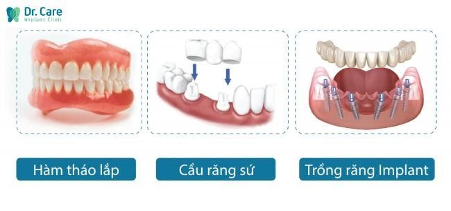 Phương pháp trồng răng giả