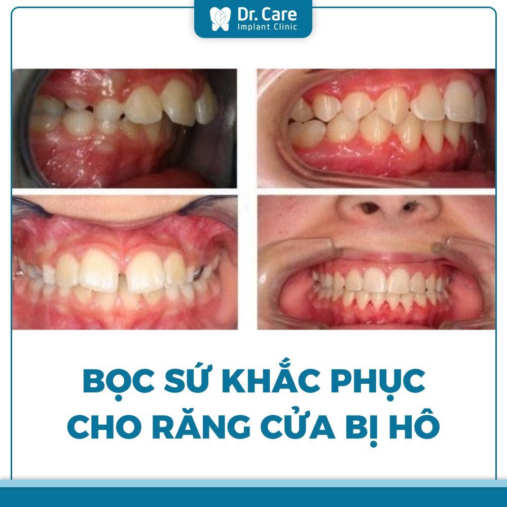 Bọc sứ 2 răng cửa bị hô có tốt không? Ưu điểm bọc sứ 2 răng cửa