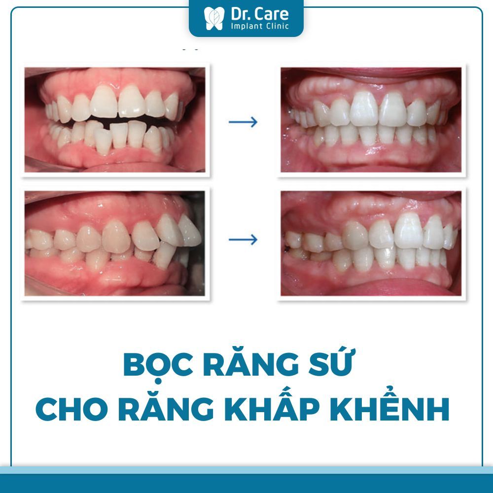 Bọc răng sứ để khắc phục tình trạng răng khấp khểnh 