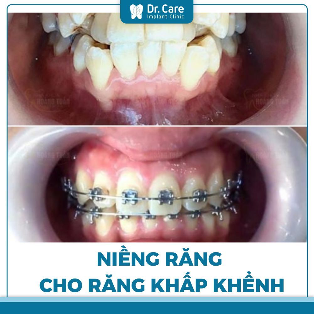 Niềng răng khắc phục tình trạng răng khấp khểnh