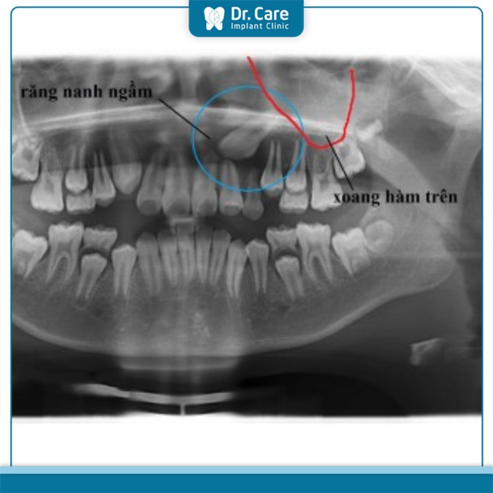 Nguyên nhân phổ biến gây đau nhức răng