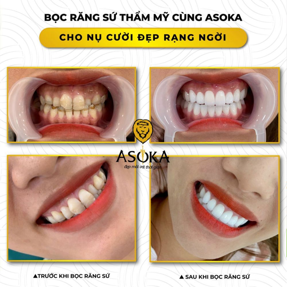 Bọc răng sứ ở đâu uy tín?