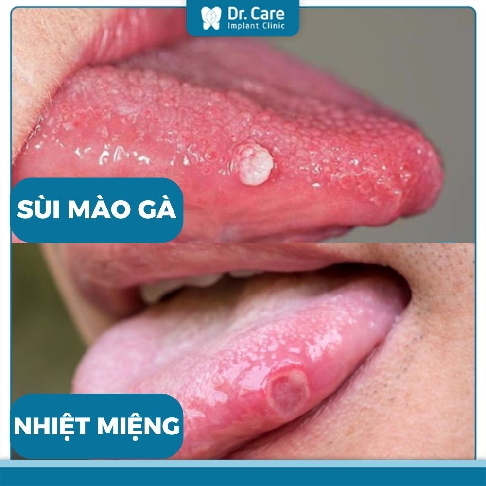 Phân biệt sùi mào gà ở miệng lưỡi với nhiệt miệng