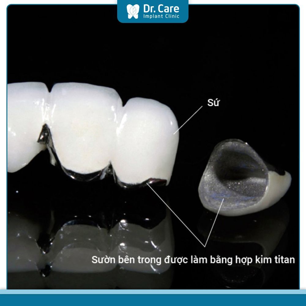 Những điều cần lưu ý để lựa chọn răng sứ uy tín, chất lượng