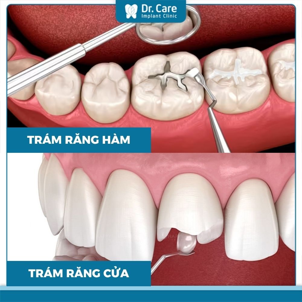 Trám răng thẩm mỹ giá bao nhiêu?