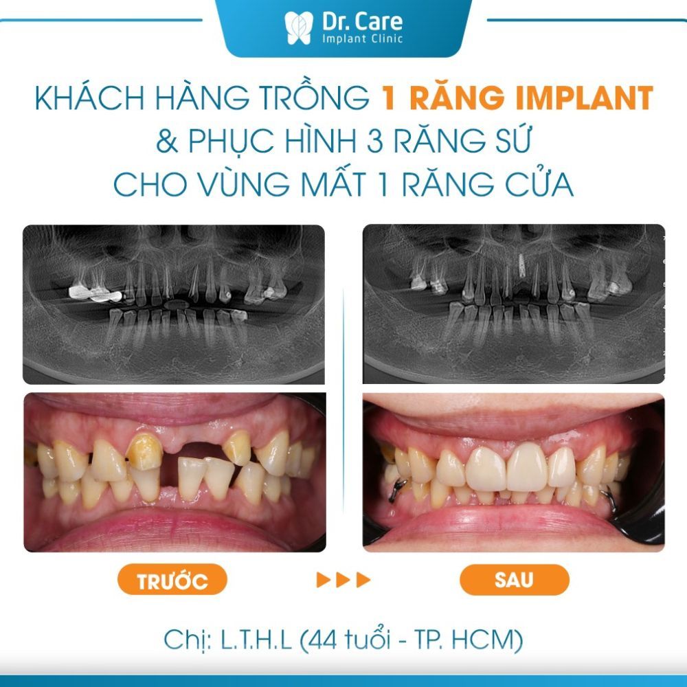 Các phương pháp làm răng sứ hiện nay