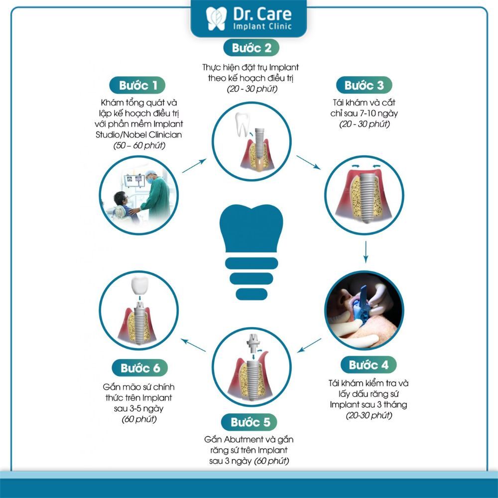 Tham khảo quy trình trồng răng giả nguyên hàm bằng phương pháp cấy ghép Implant