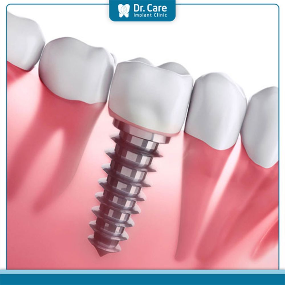 Mất răng nguyên hàm nên cấy ghép Implant hay trồng răng tháo lắp sẽ tiết kiệm chi phí?