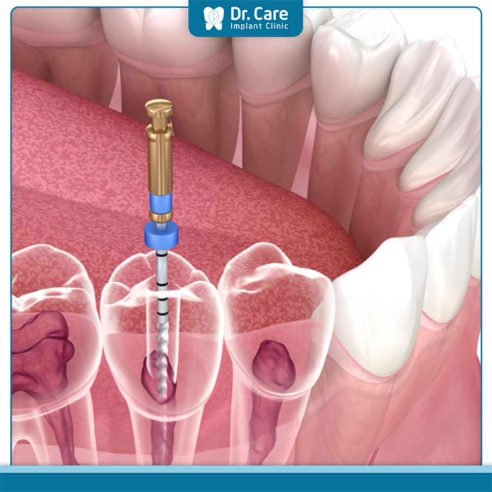 Cách điều trị tình trạng chết tủy răng