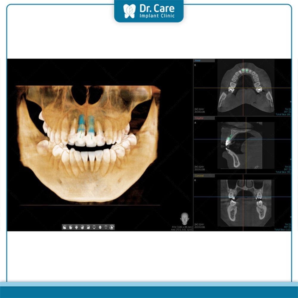 Ứng dụng của CBCT trong điều trị nha khoa